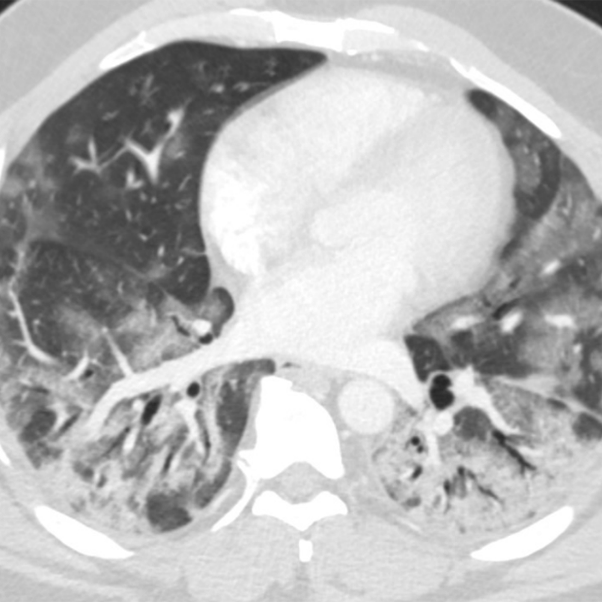 AI Assists in COVID-19 Diagnosis and Prognosis