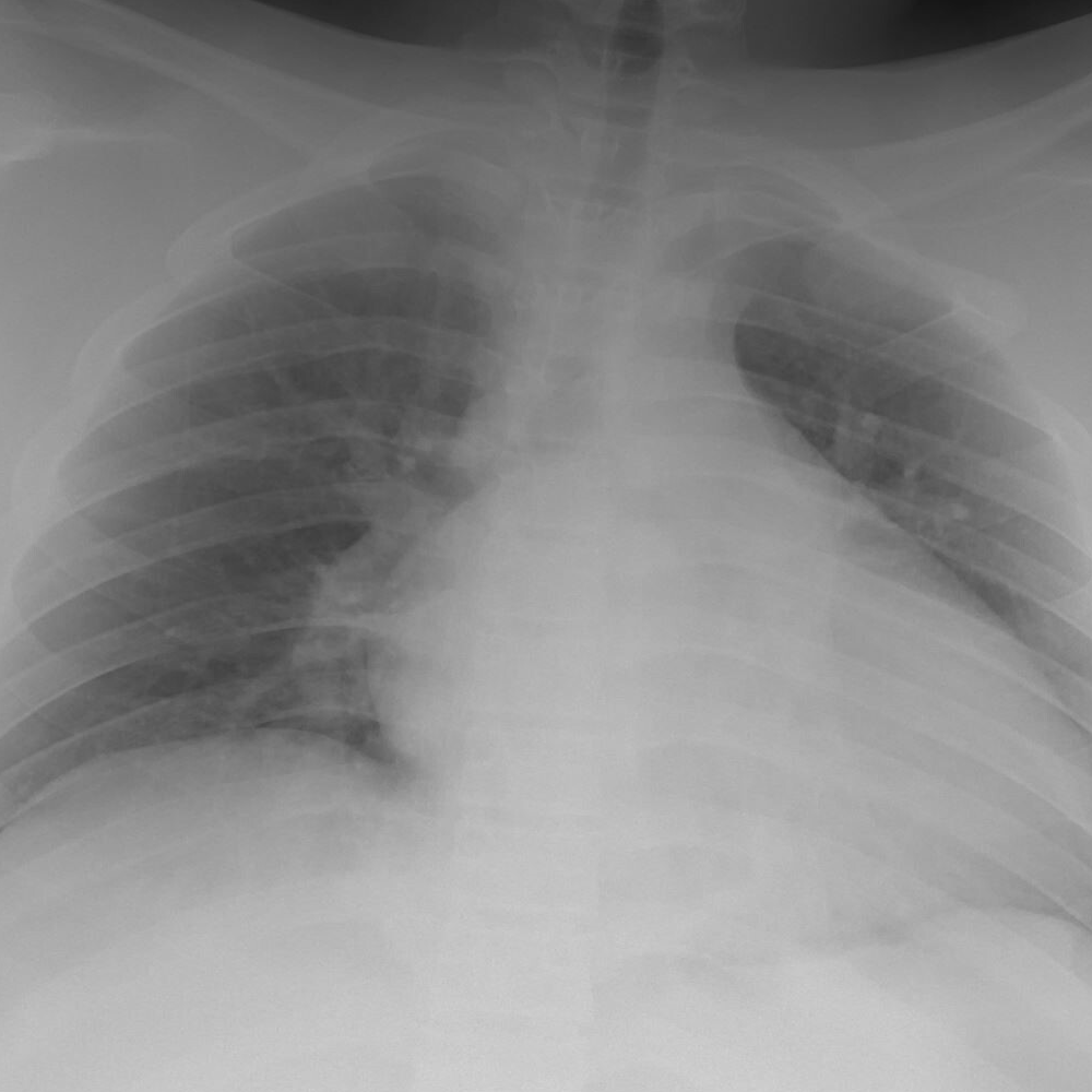 Pediatric COVID-19 and MIS-C: What Lies Beyond Pneumonia?