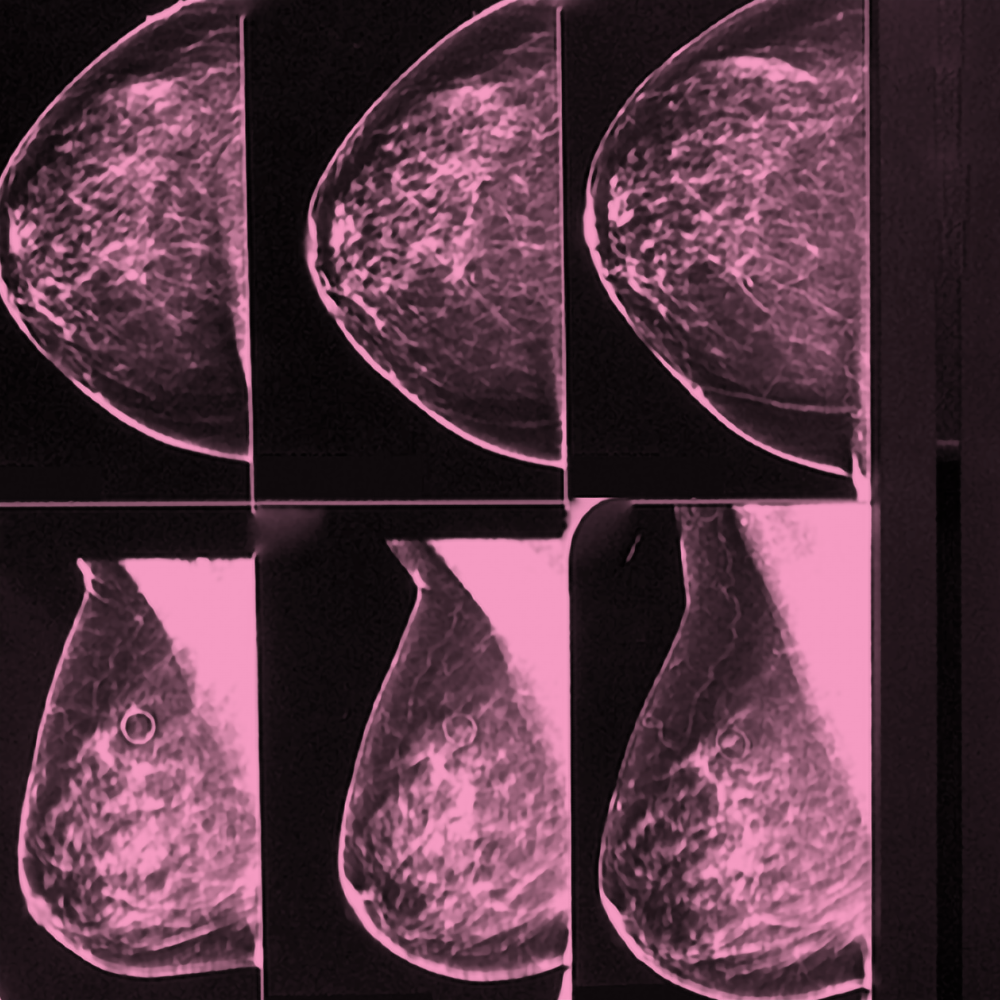 Breast Imaging During COVID-19