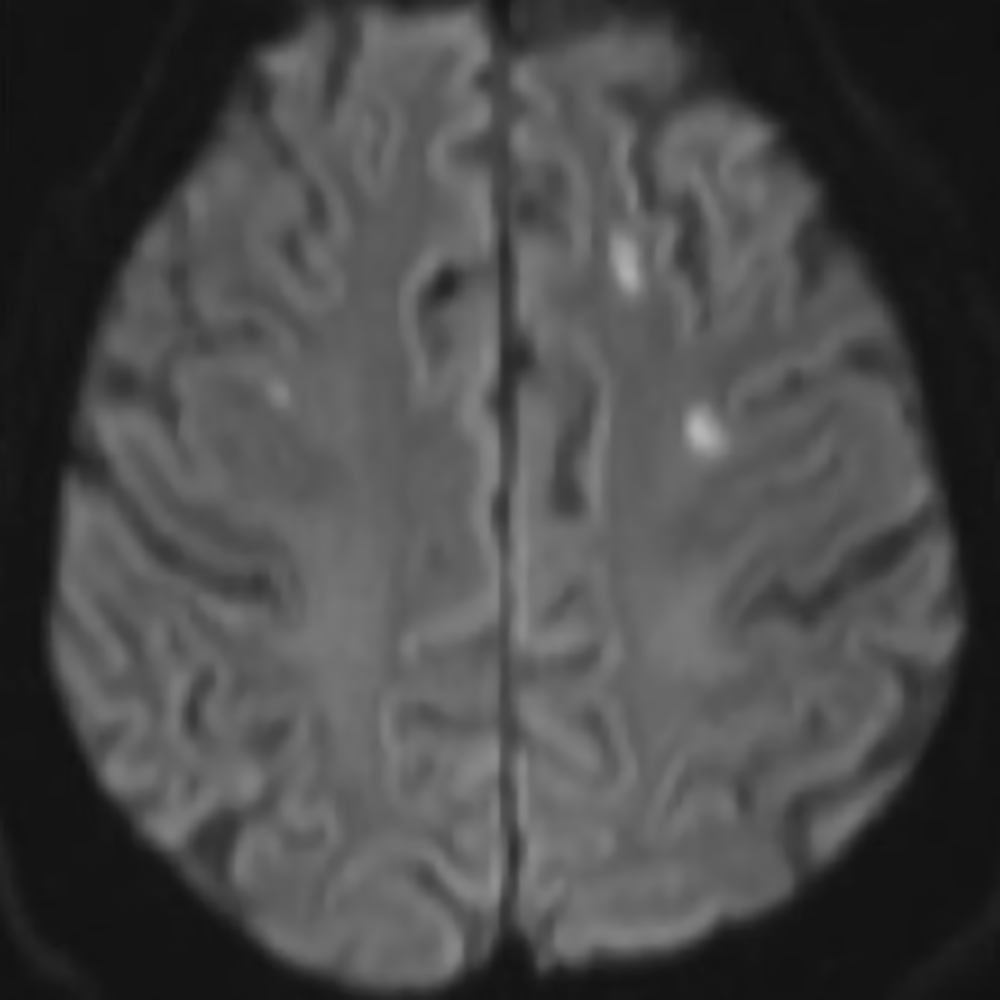 Neurological Manifestations of COVID-19: Insights for the Diagnostic Radiologist