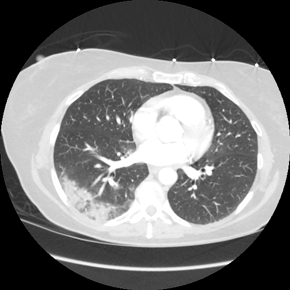 Imaging Patients with COVID-19: Current Perspective