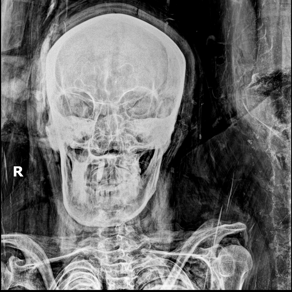 Imaging the Past in Situ: Paleoradiology and the Saqqara Necropolis Excavation