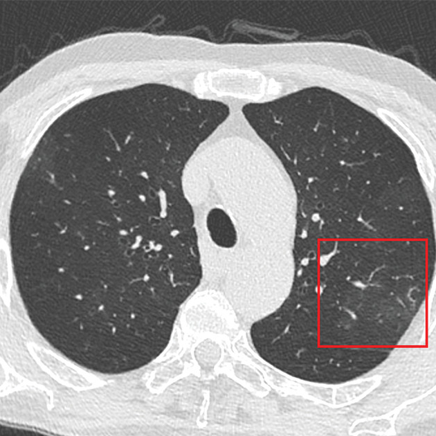 COVID-19 in Colombia: A New Trigger for Health Care Disparities
