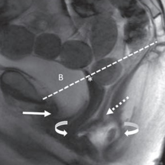 ARRS Partners With Pelvic Floor Disorders Consortium on MRI Defecography Guidelines
