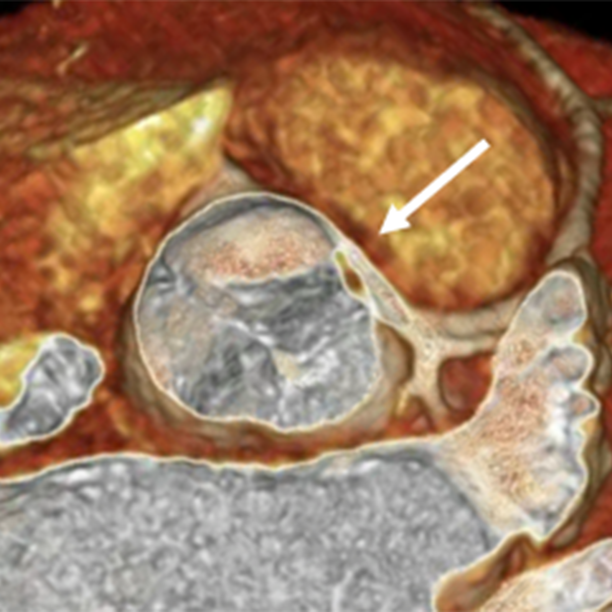 Cardiac Events in Athletes
