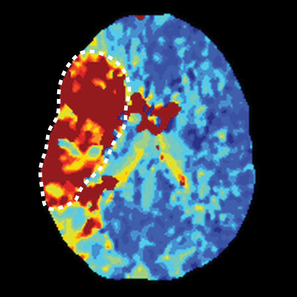 Acute Ischemic Stroke: Treatment and Imaging Updates