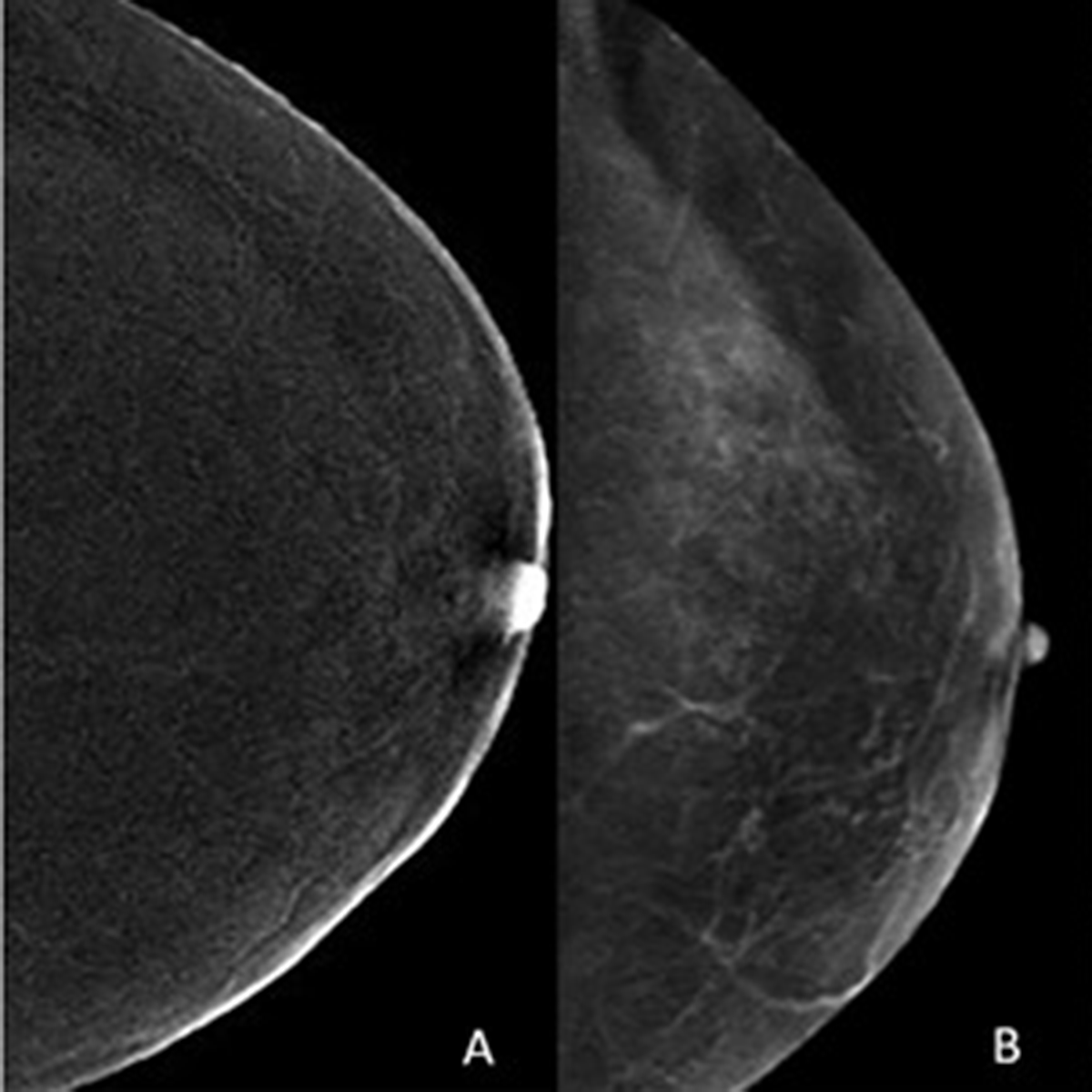 Moving Forward With Contrast-Enhanced Mammography