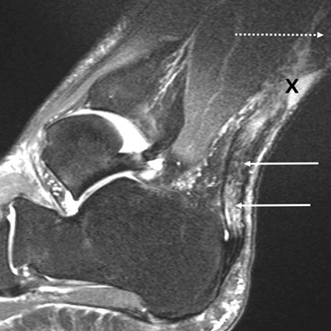Three Challenging Cases in Ankle Imaging: How to Make the Diagnosis