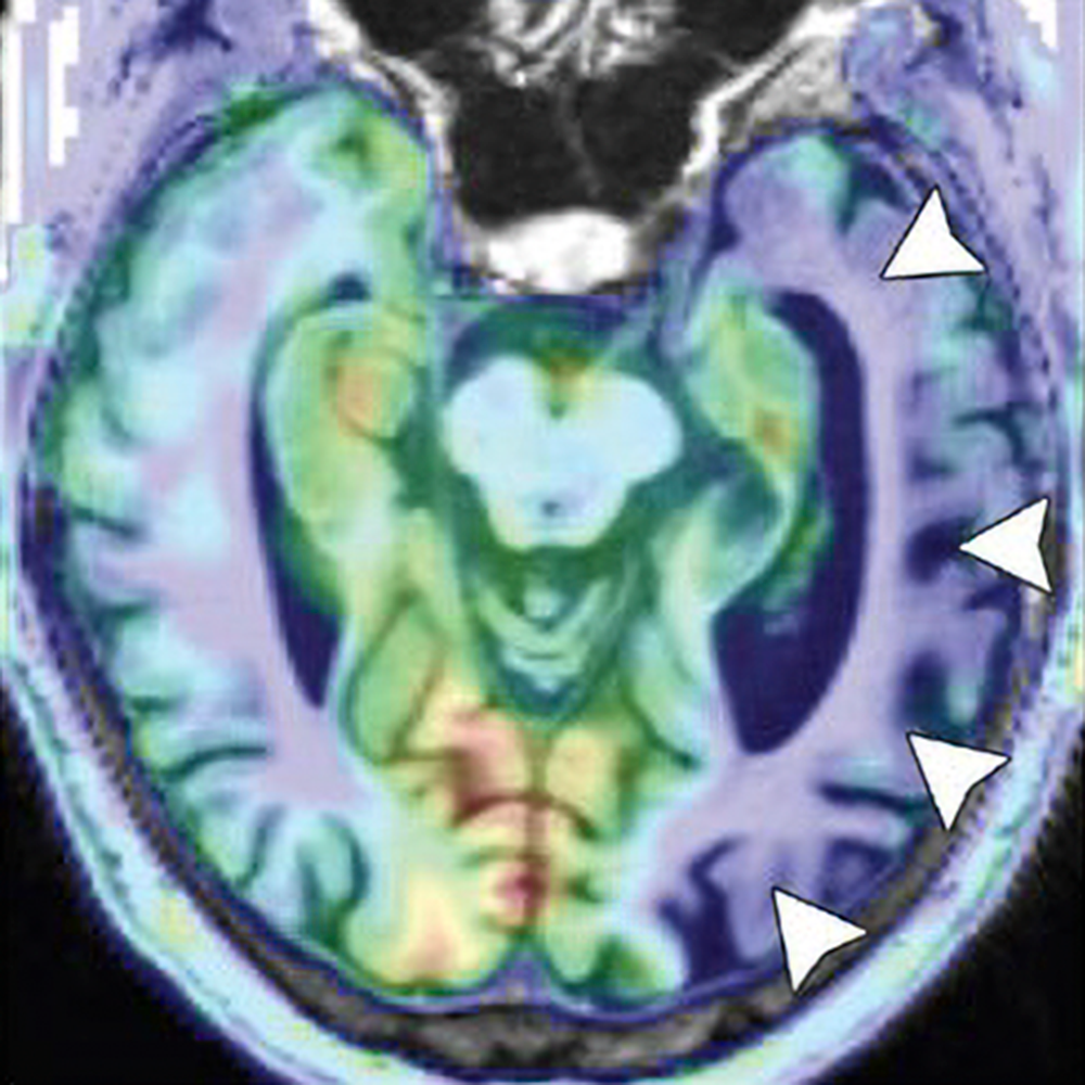 Pitfalls and Challenging Cases in Dementia Imaging