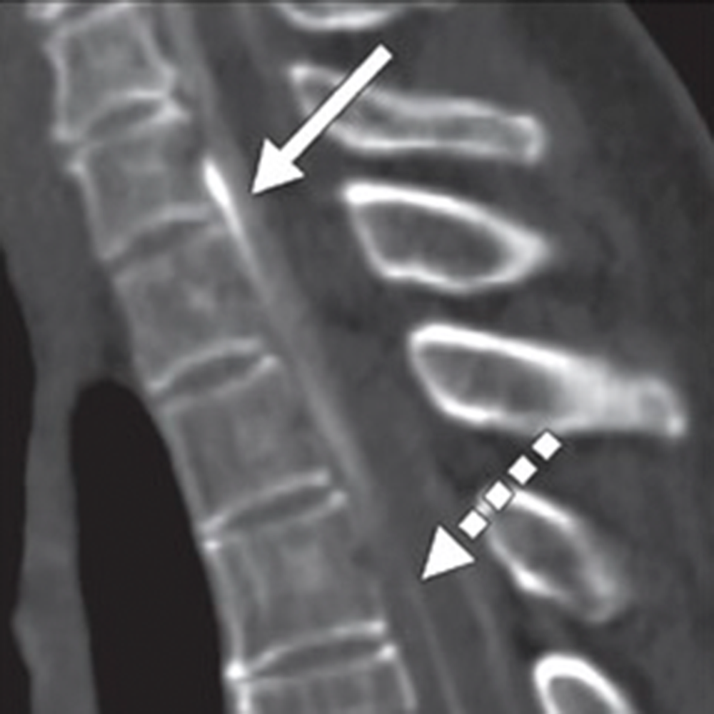 Finding the Leak: Tips for CSF Leak and Venous Fistula Localization