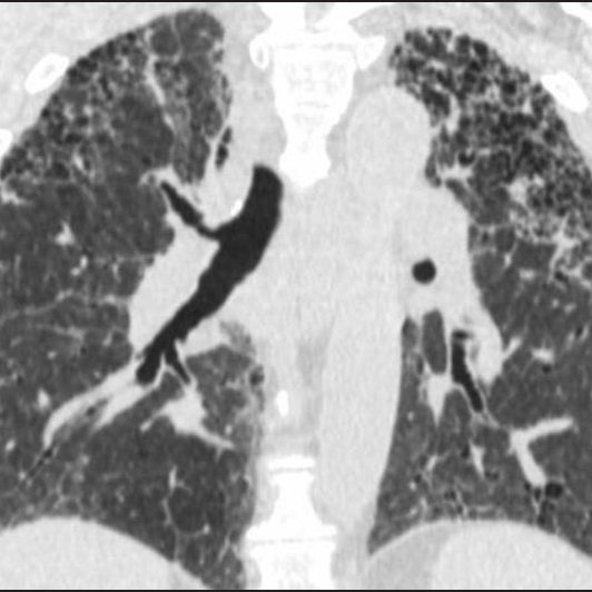 Diagnosing Interstitial Lung Disease