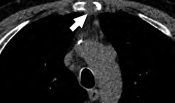 Barriers & Facilitators—Lung Cancer Screening Equity in Individual, Provider, and Community Practice