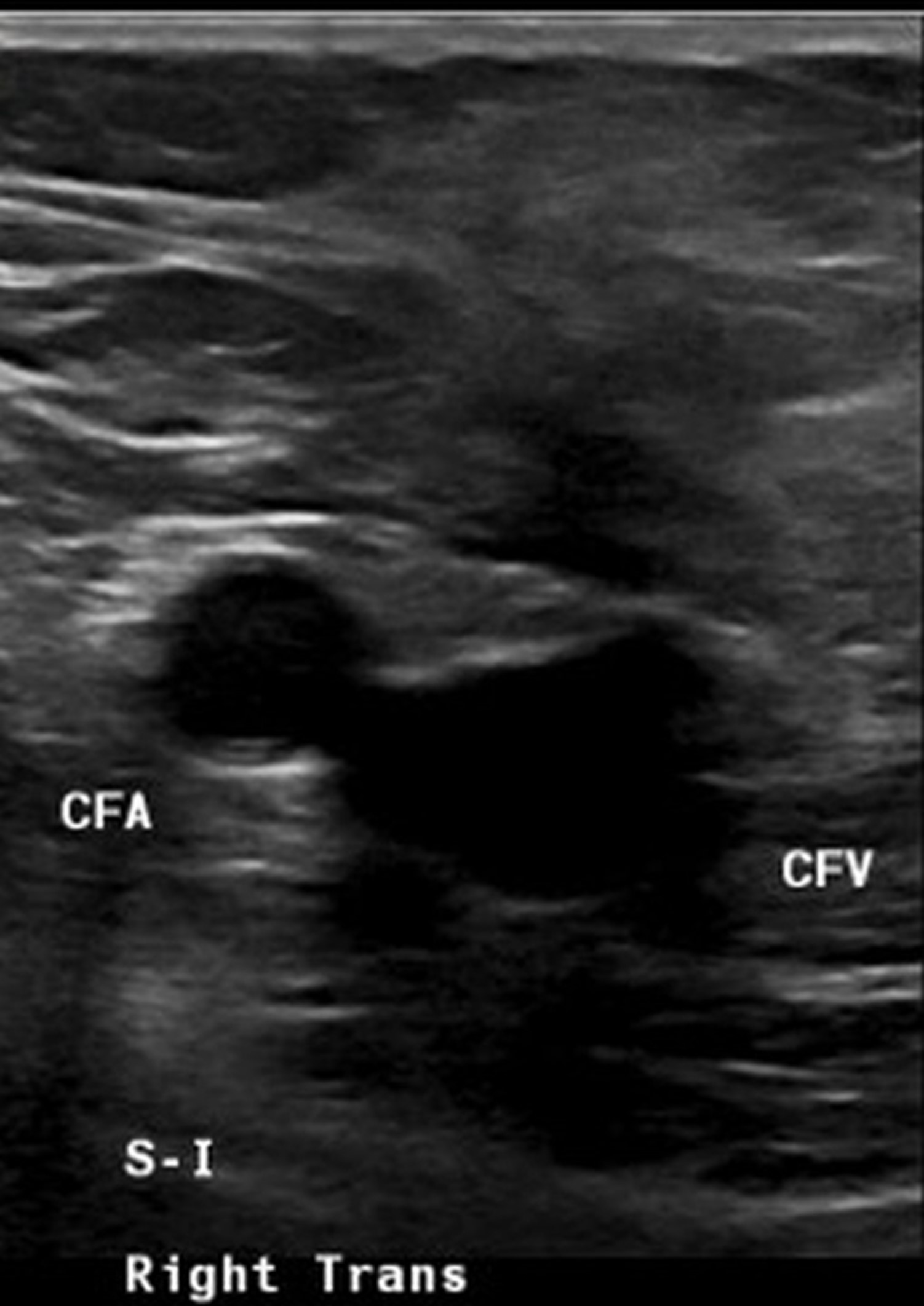 Society of Radiologists in Ultrasound to Illustrate Consensus Statements at ARRS 2025 in San Diego