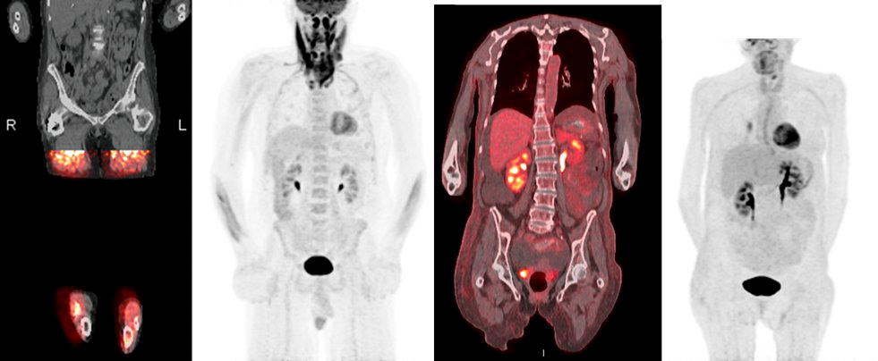 Expensive, Inferior, and Protracting—Inpatient FDG PET/CT