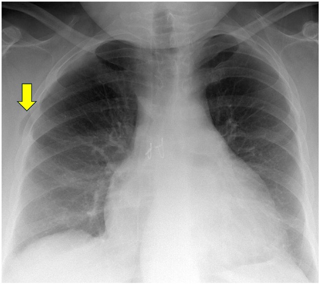Imaging and Recognition of Early Postoperative Lung Transplant Complications