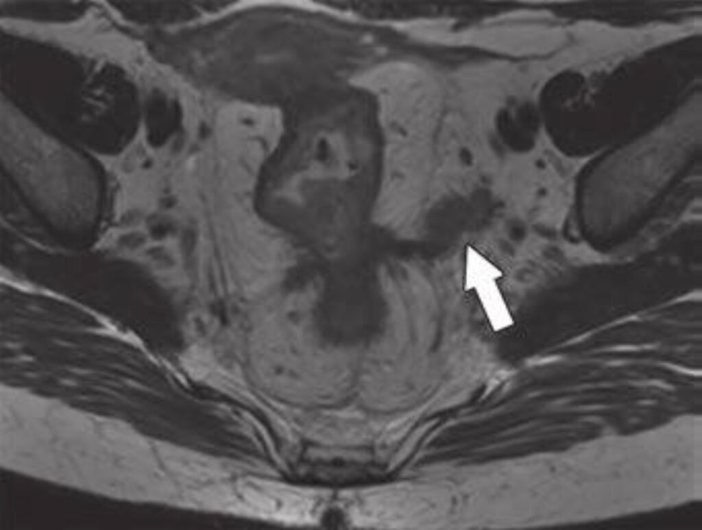 Precision Imaging in Rectal Cancer: ARRS, RANZCR to Sharpen Staging and Surveillance