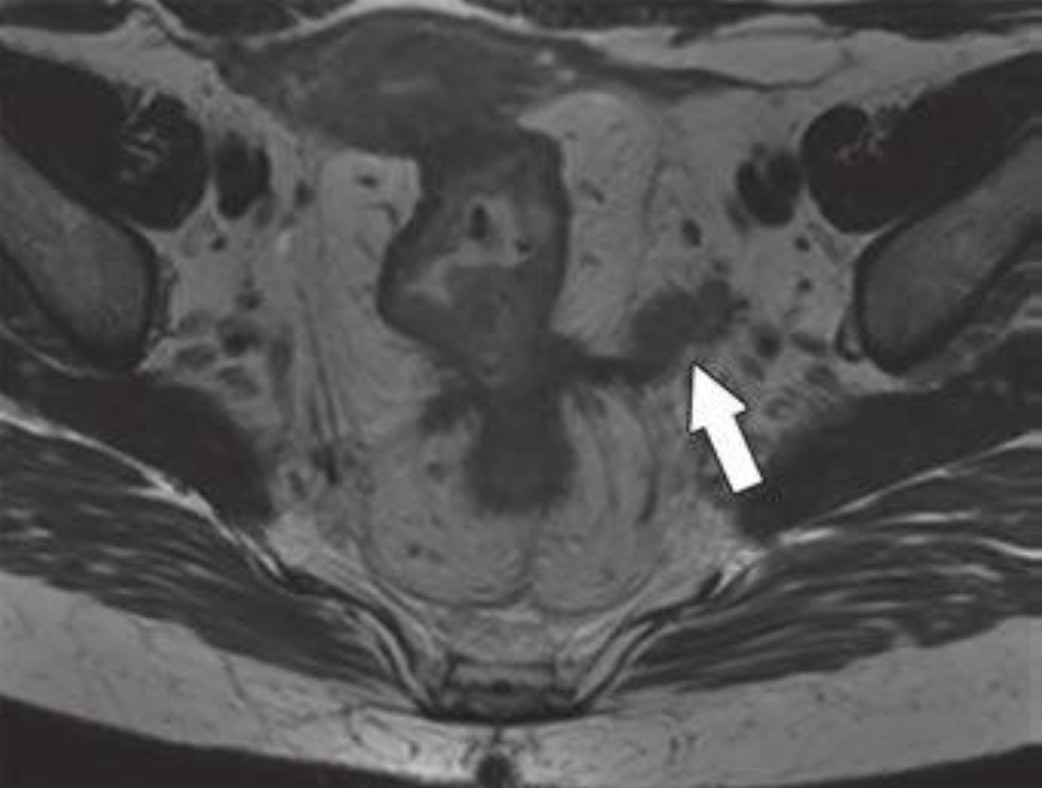 Precision Imaging in Rectal Cancer: ARRS, RANZCR to Sharpen Staging and Surveillance