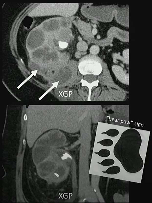 The Bear Paw Sign: Classic Clues to Xanthogranulomatous Pyelonephritis (XGP)