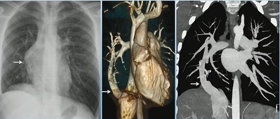 Scimitar Syndrome with Horseshoe Lung: Key Imaging Clues