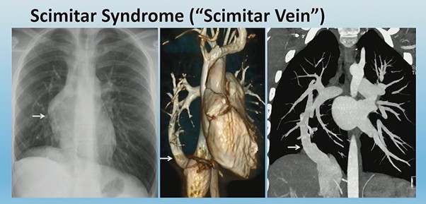 Scimitar Syndrome with Horseshoe Lung: Key Imaging Clues