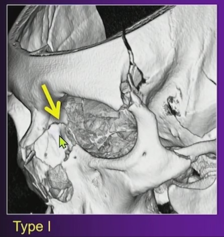 Markowitz and Manson Classification: Why It Matters in Orbital Trauma Reporting