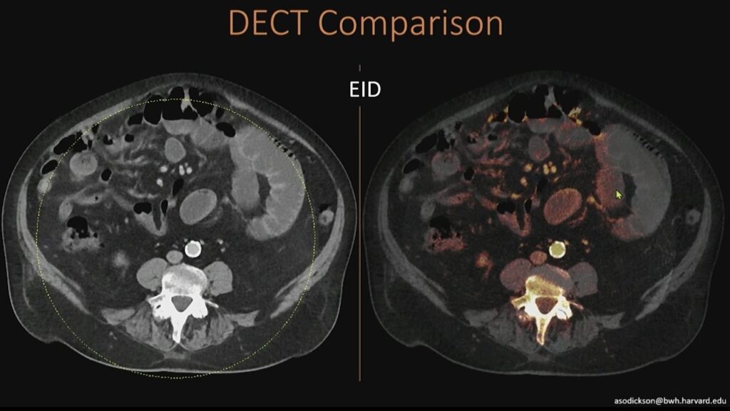 DECT to the Edges: Photon-Counting CT in the ED – RadFYI