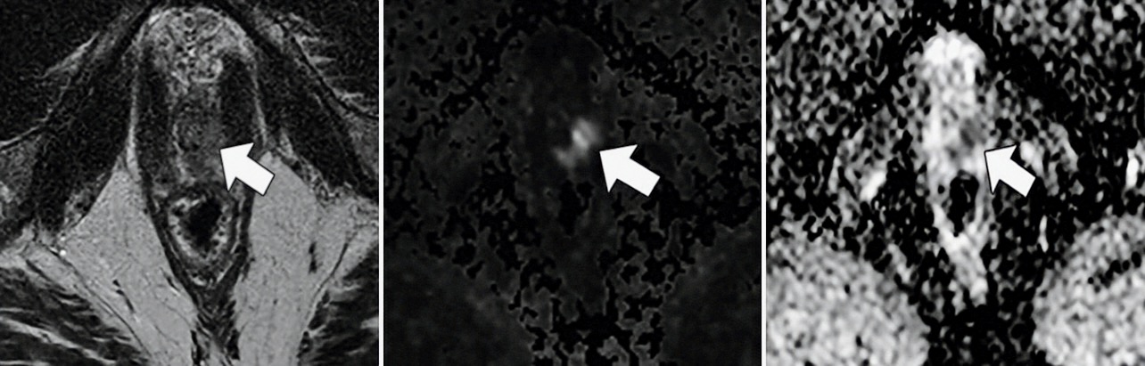 Nomograms for Stratifying Prostate Cancer Risk—Where Imaging Changes the Equation