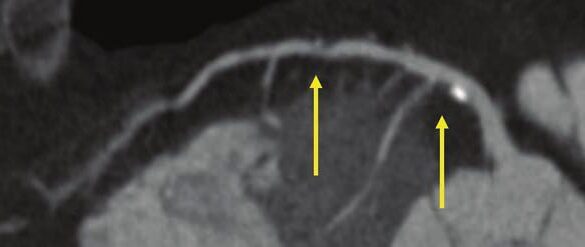CMS May Undo a 104% CCTA Payment Increase