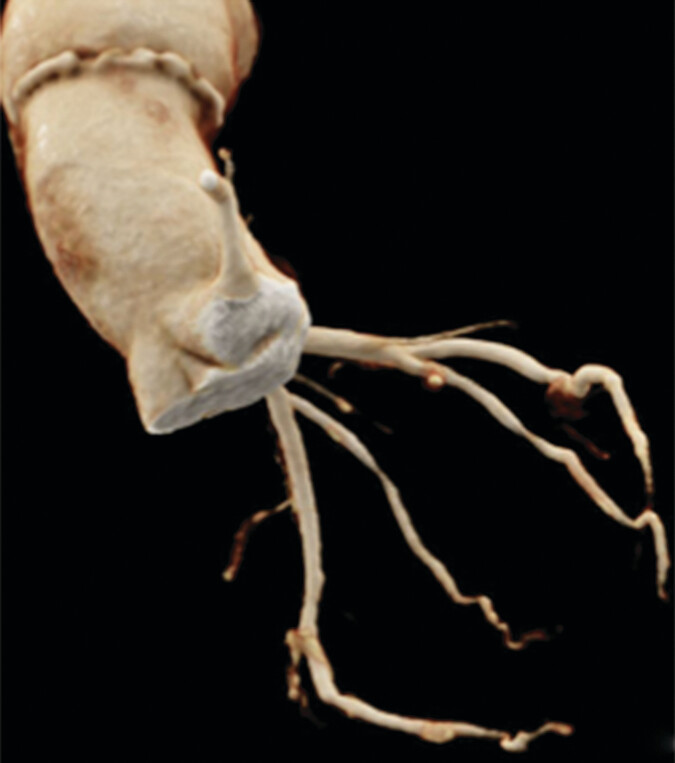 Act Now, or Lose 104% CCTA Reimbursement Bump—ACR