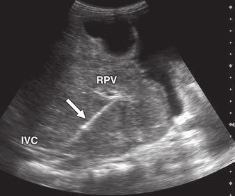 Budd-Chiari TIPS—When Decompression Becomes Definitive Therapy