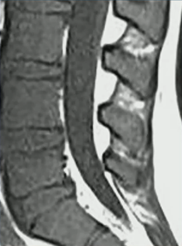 Pediatric Bone Marrow MRI—Is It Leukemia?