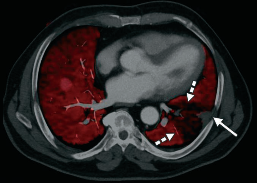 Vascular DECT: From Clot Detection to Perfusion Proof