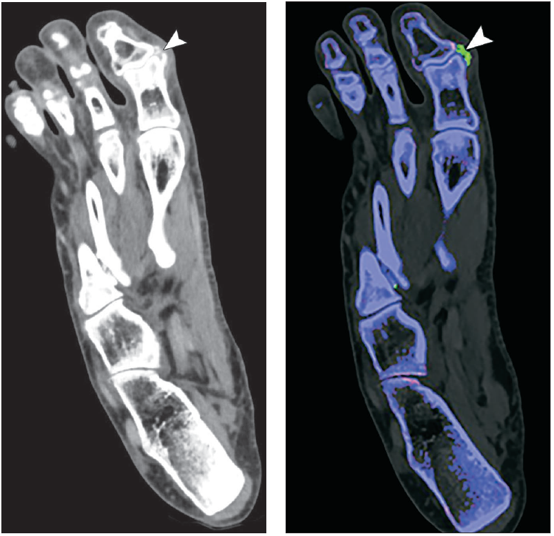 MSK DECT: Clarity Through the Metal and Beyond