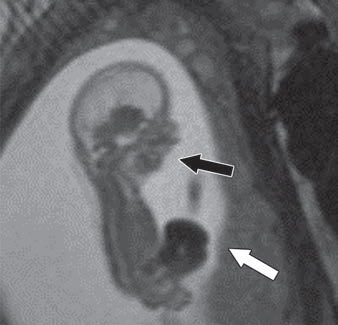 Does Your Fetal Ultrasound Need Backup? Try 3T MRI.