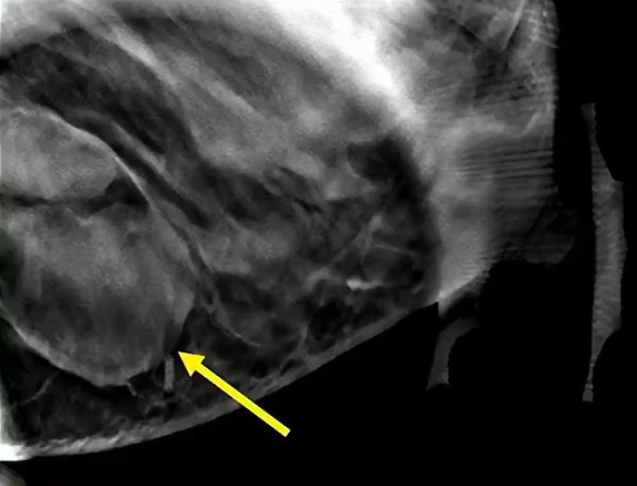 Pregnant Pitfall: Lactating Adenoma, or Something More?