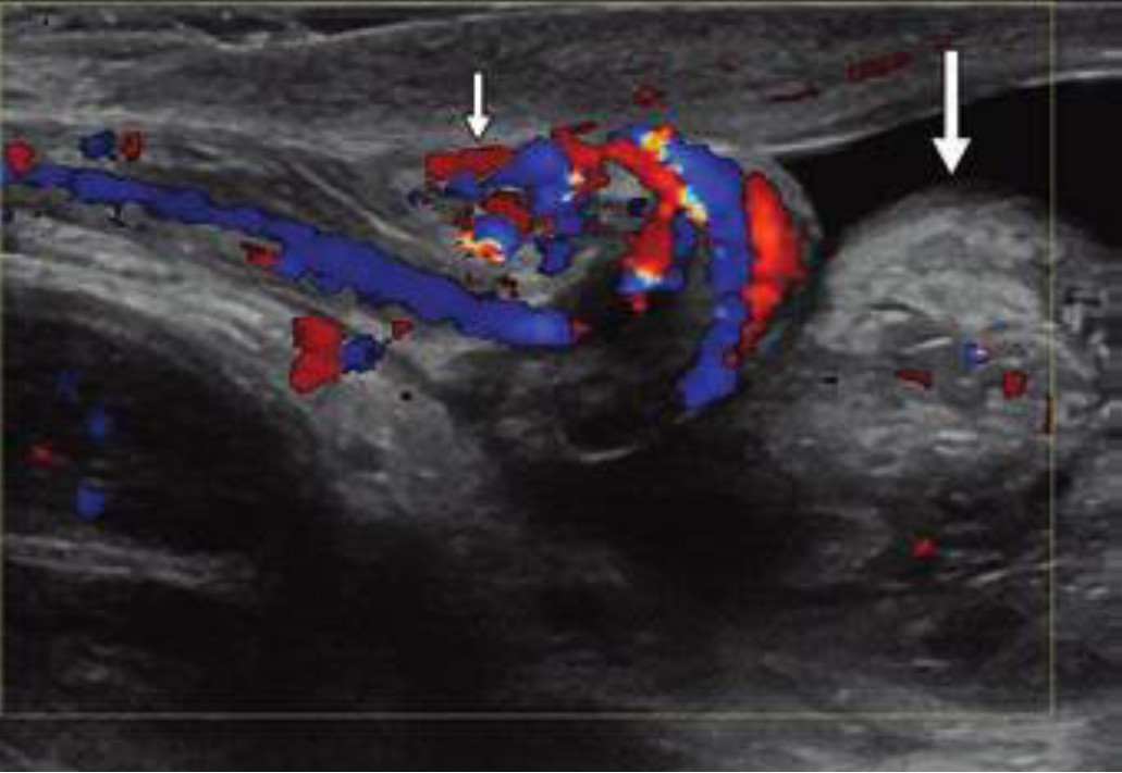 The Whirlpool Sign in Scrotal Imaging (Don’t Miss the Twist!)