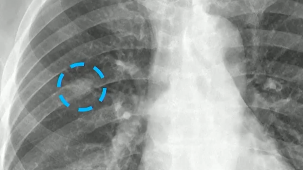 Is This Lung Nodule Real?