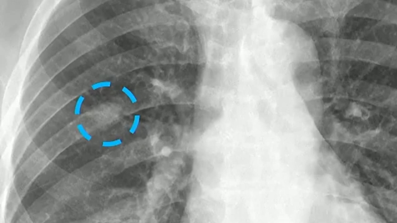 Is This Lung Nodule Real?