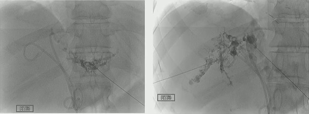 The Glaring Reality of Untreated Primary Sclerosing Cholangitis