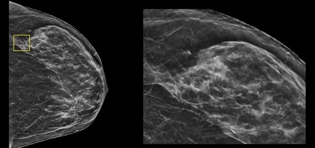 Language of Lesion: BI-RADS v2025