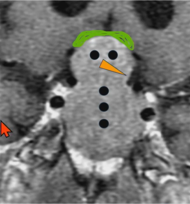 The Snowman Sign—Pituitary Macroadenoma