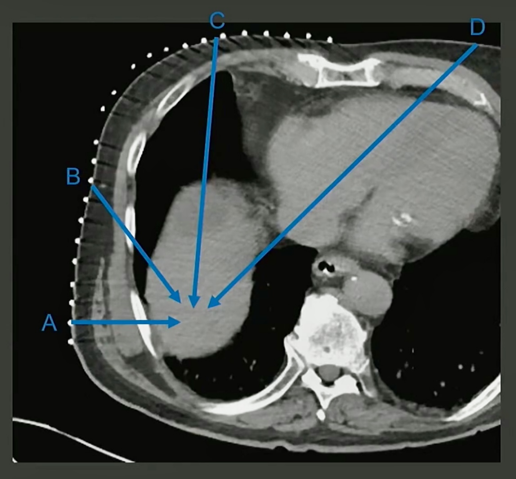 Ablating HCC Near the Dome? Drop the Lung.