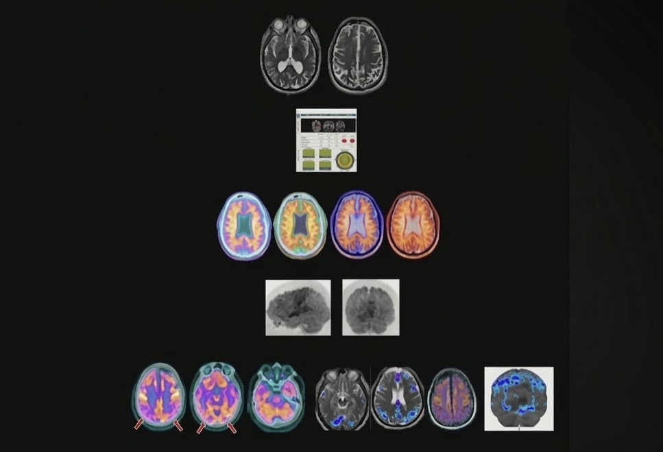 Decoding Dementia: The Lewy Body Problem
