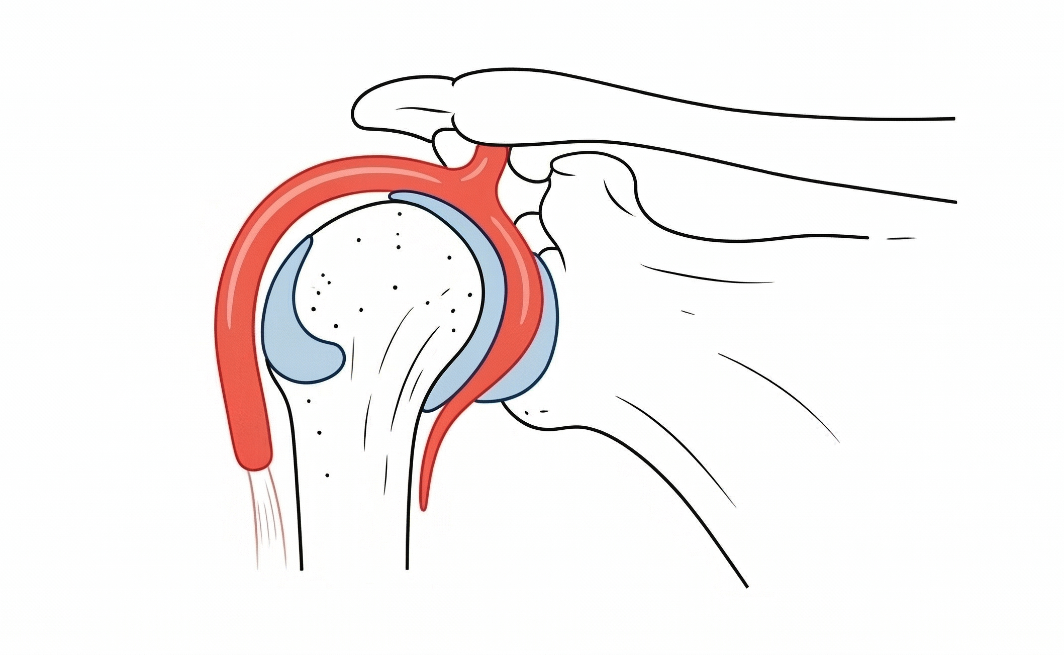 The Buford Complex—Anatomy or Abnormality?