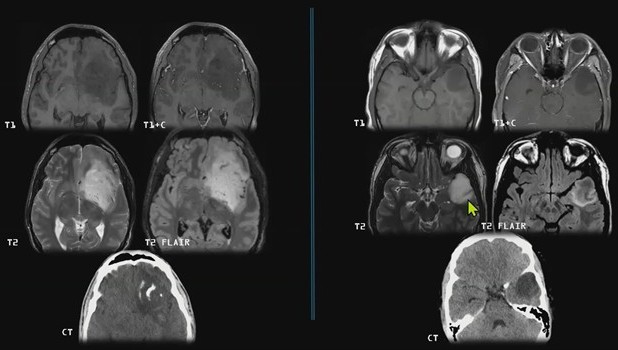 Infiltrative Mass Faceoff: Oligodendroglioma vs. IDH-Mutant Astrocytoma