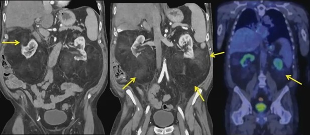 Perirenal Fat Trap: Spotting Extra-Adrenal Myelipoma