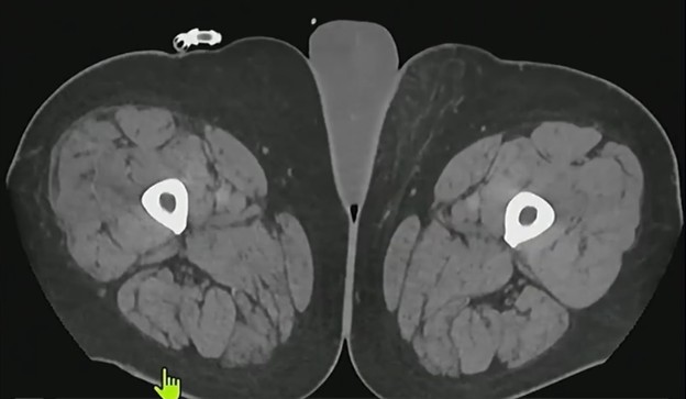 Fournier’s Gangrene: A Urologic Emergency