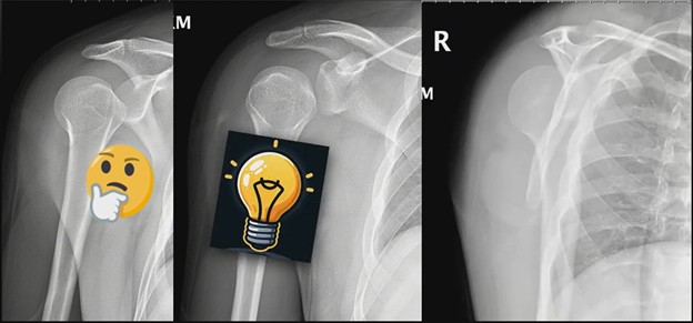 Posterior Shoulder Dislocations—Lights Up!