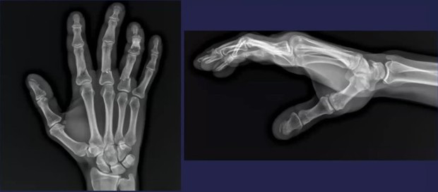 The Snow Blower and The Tuft Fracture
