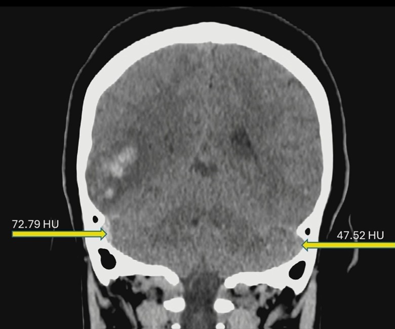 ER Headache? Don’t Miss the Sinus.